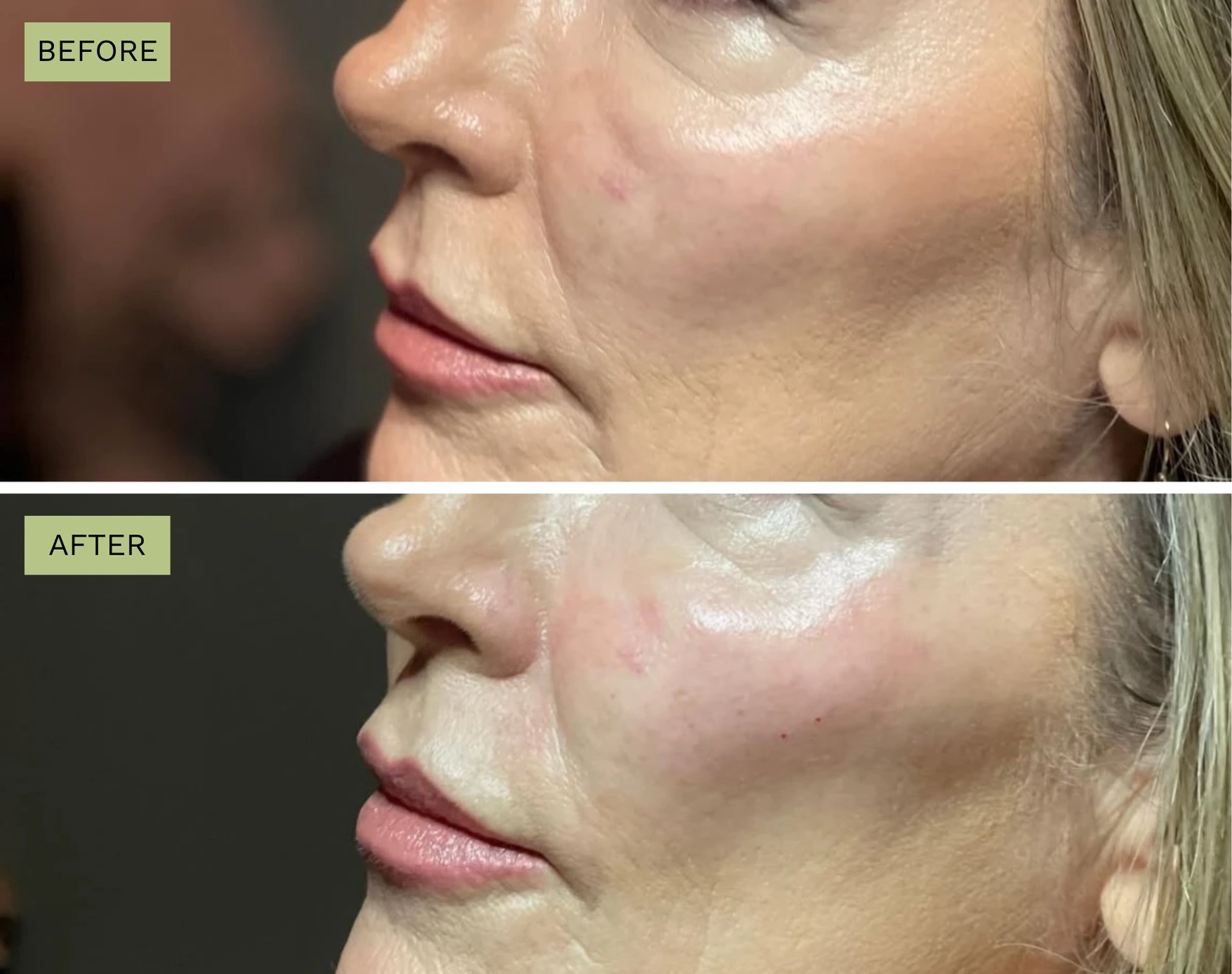 Elite Cheeks - Melanie Hartsell, APRN-C