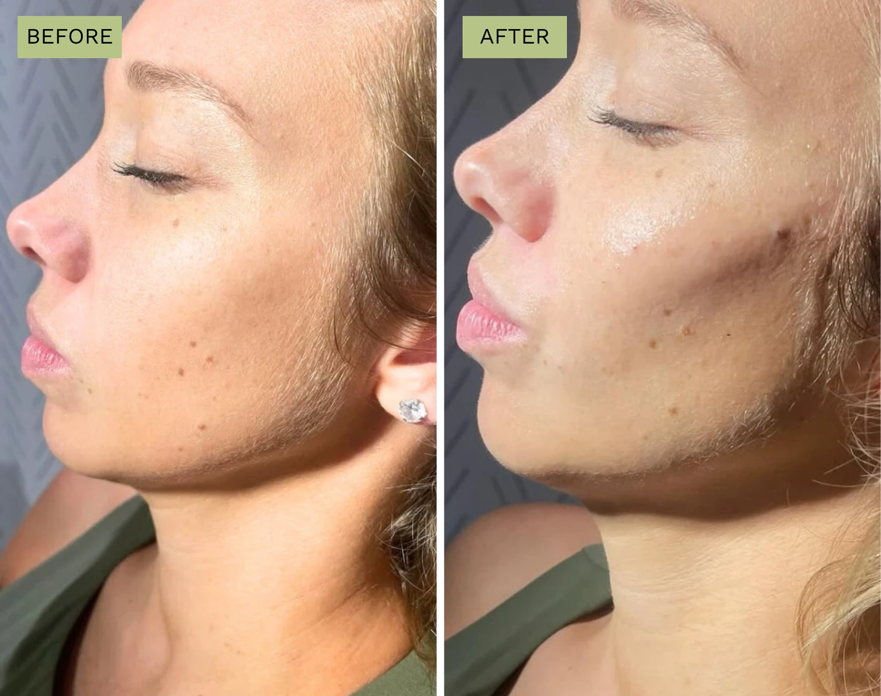 Elite Cheeks - Melanie Hartsell, APRN-C