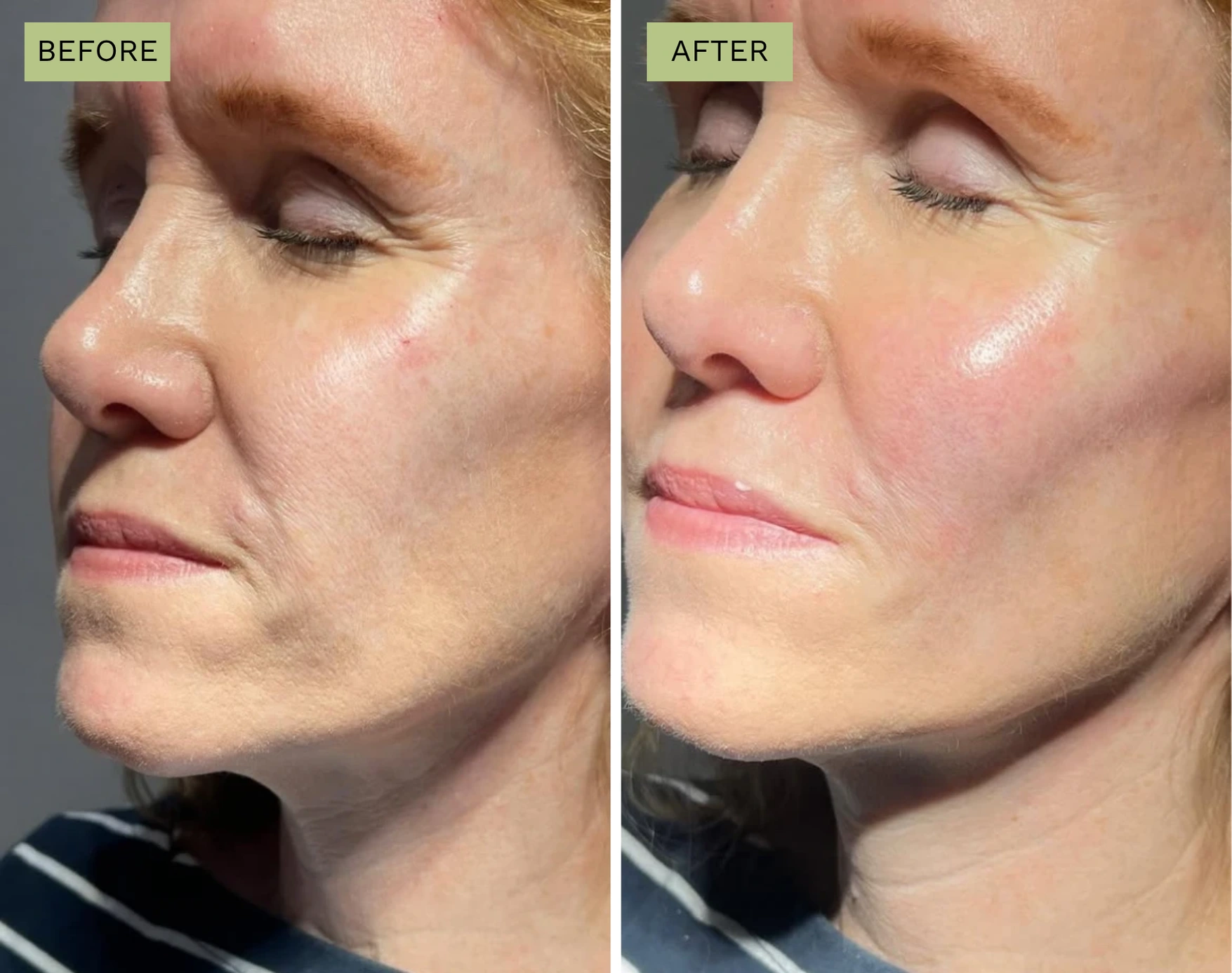 Elite Cheeks - Melanie Hartsell, APRN-C