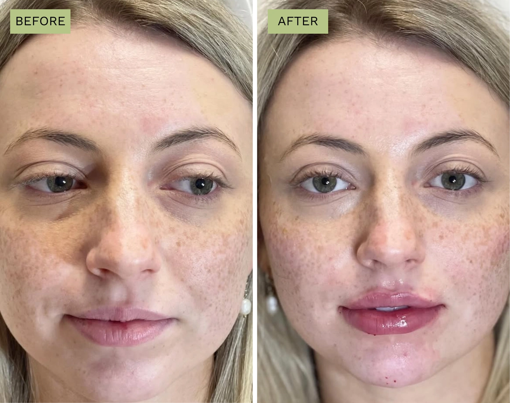 Elite Cheeks - Melanie Hartsell, APRN-C