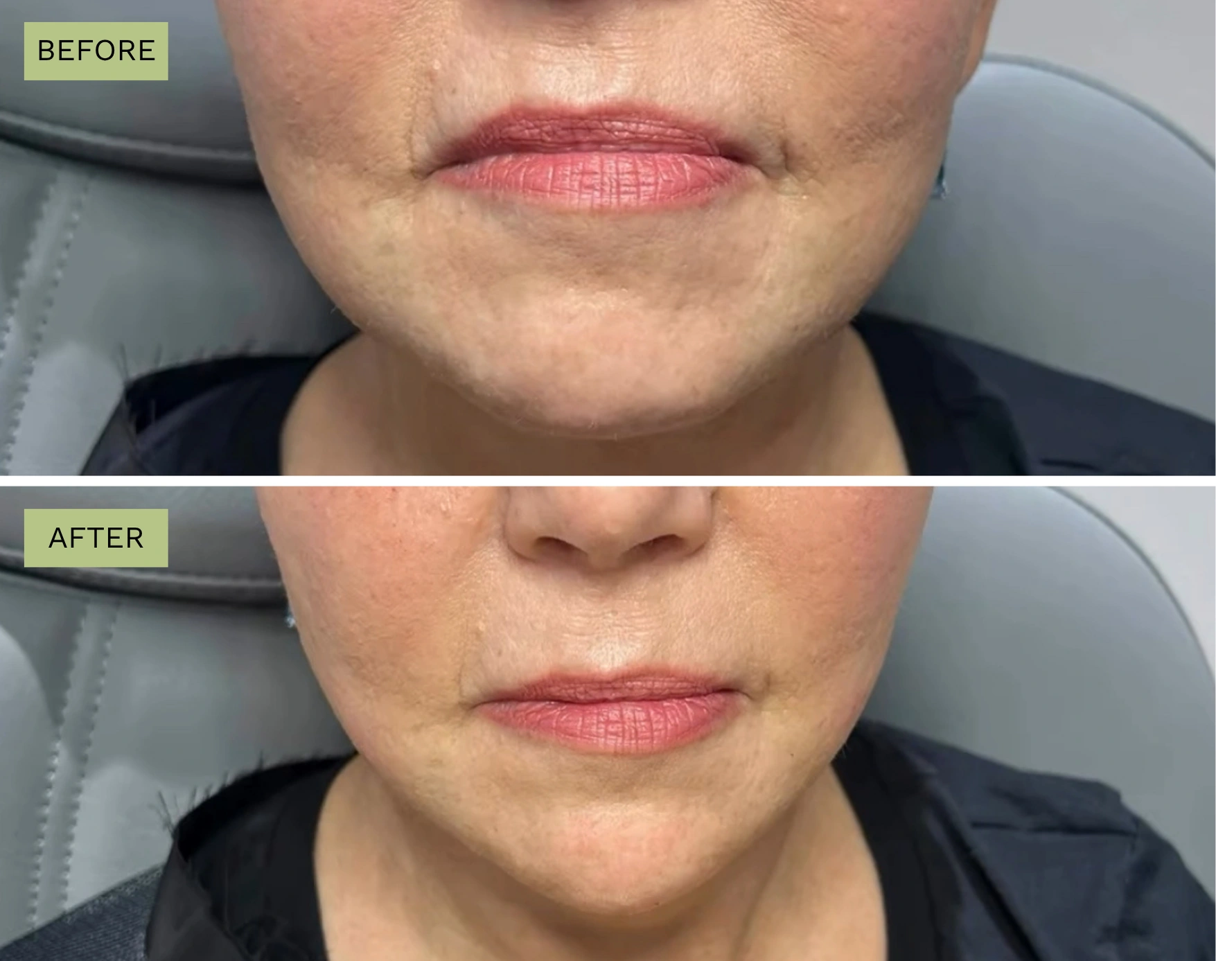 Elite Chin – Jeff Goldstein, PA-C