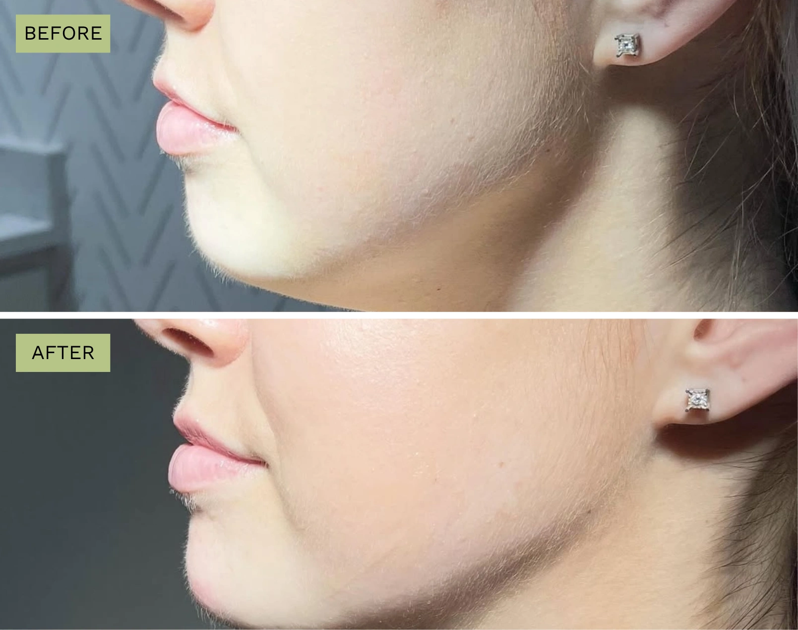 Elite Chin - Melanie Hartsell, APRN-C