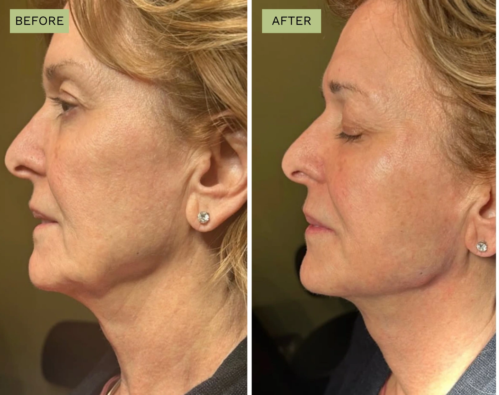 Elite Jawline - Jeff Goldstein, PA-C