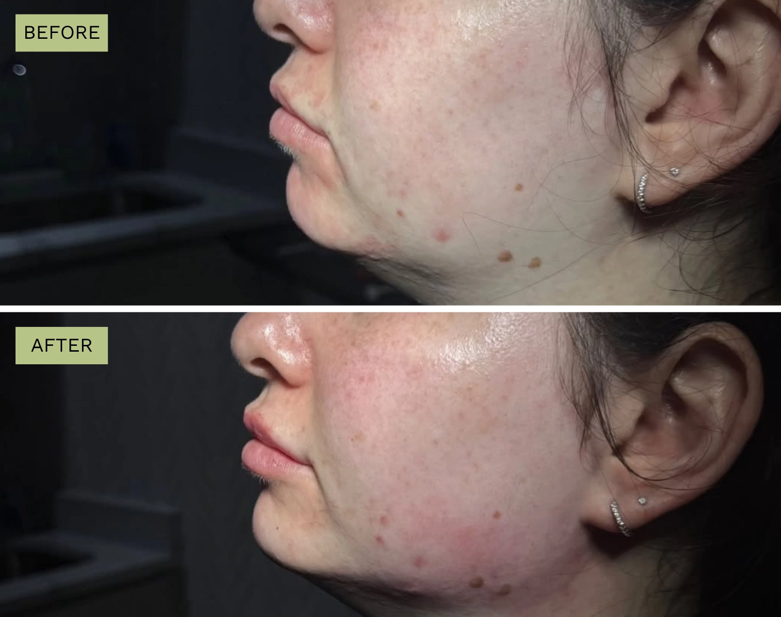 Elite Jawline - Melanie Hartsell, APRN-C