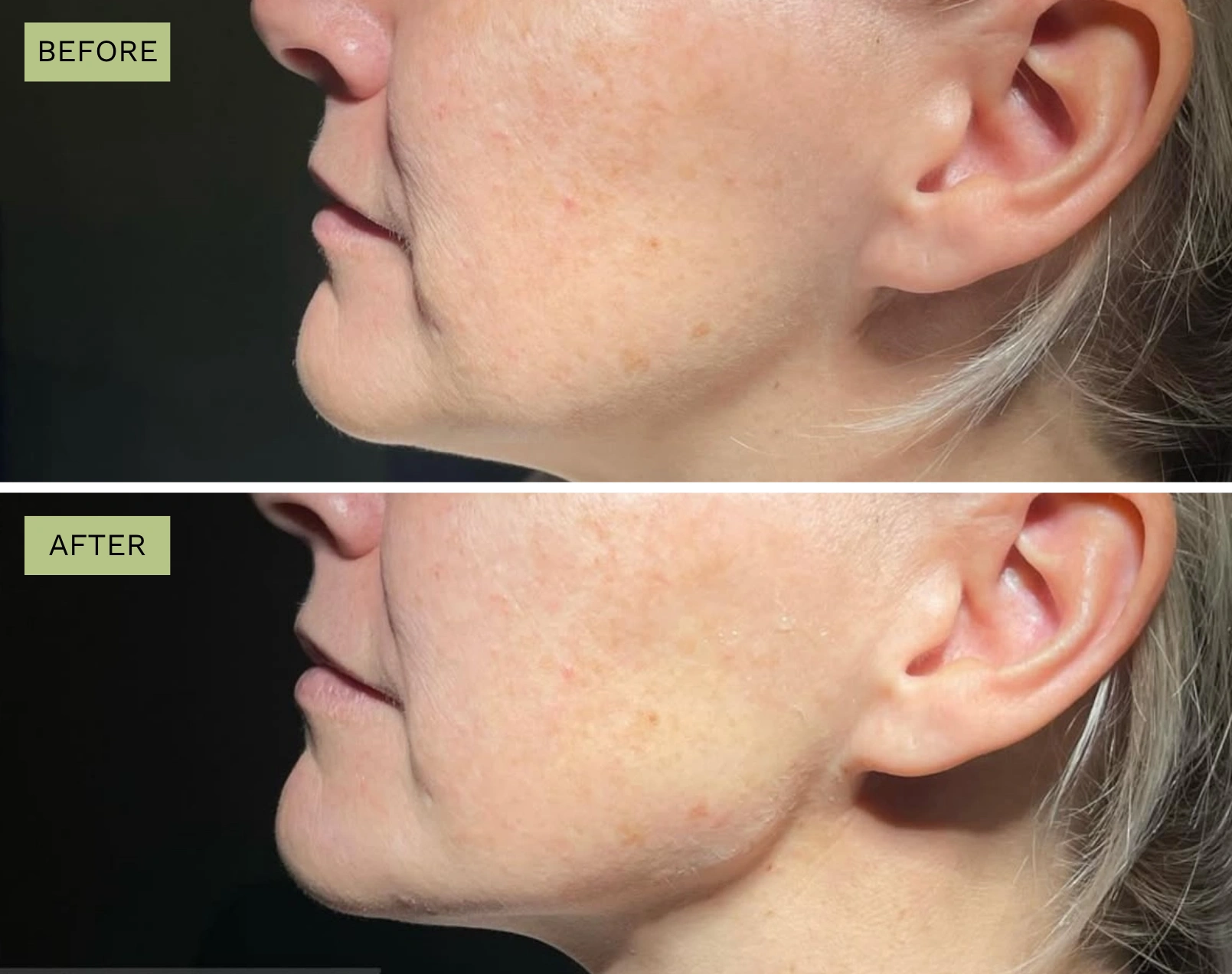 Elite Jawline - Melanie Hartsell, APRN-C
