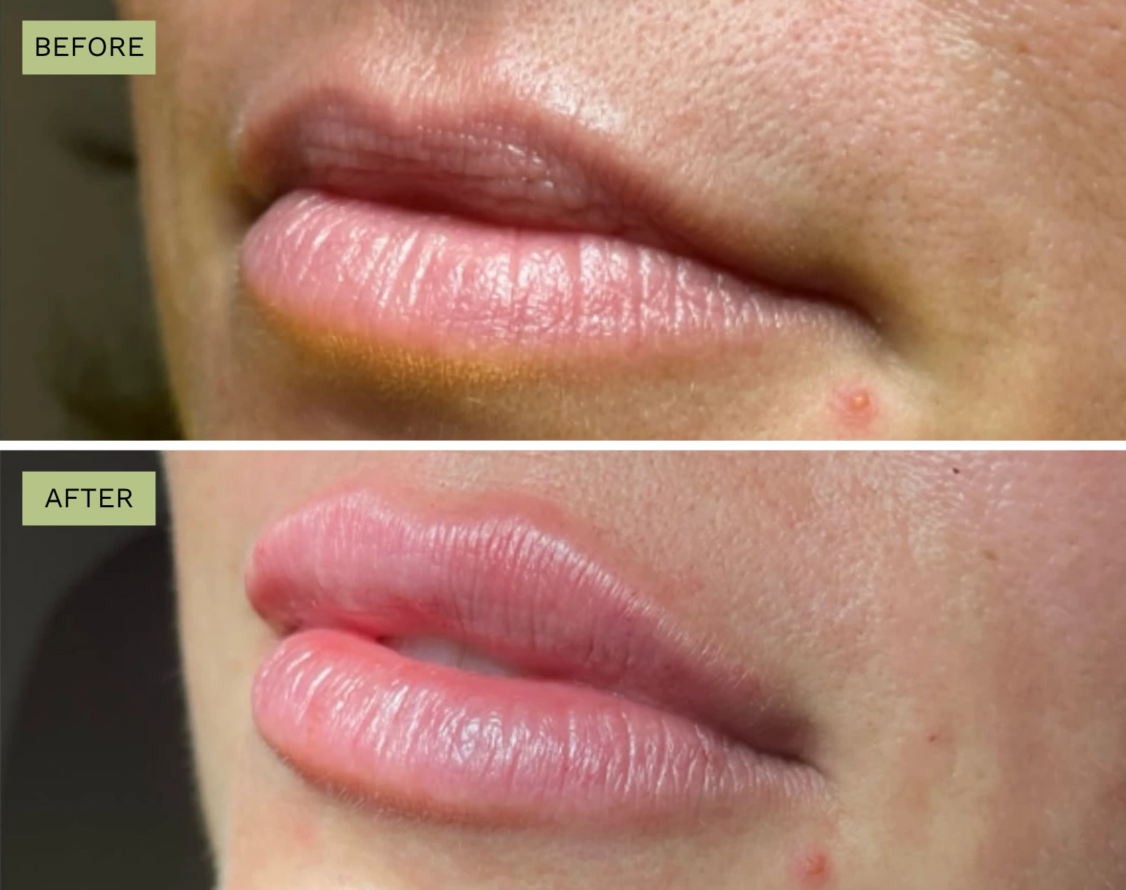 Elite Lips -Jeff Goldstein, PA-C