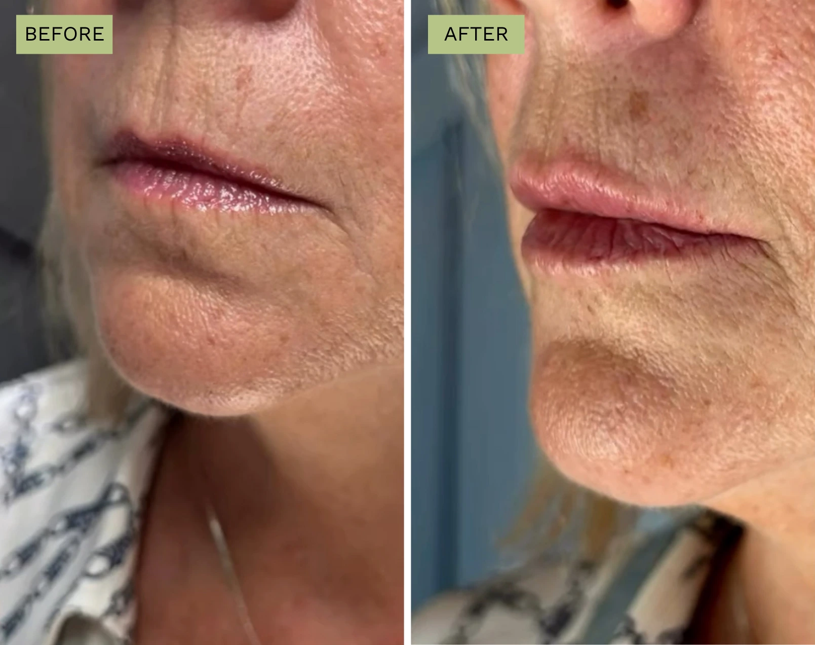Elite Lips -Jeff Goldstein, PA-C