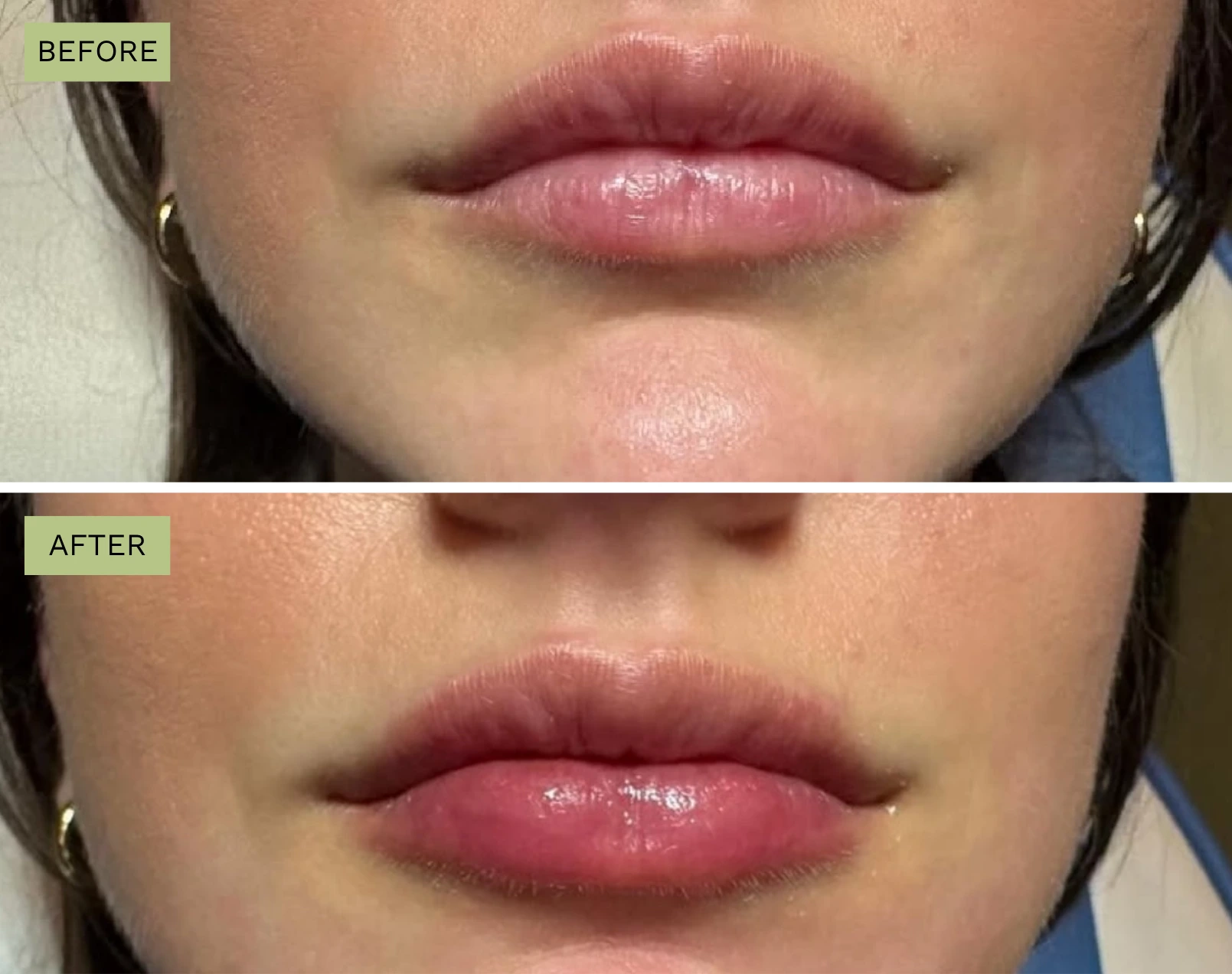Elite Lips