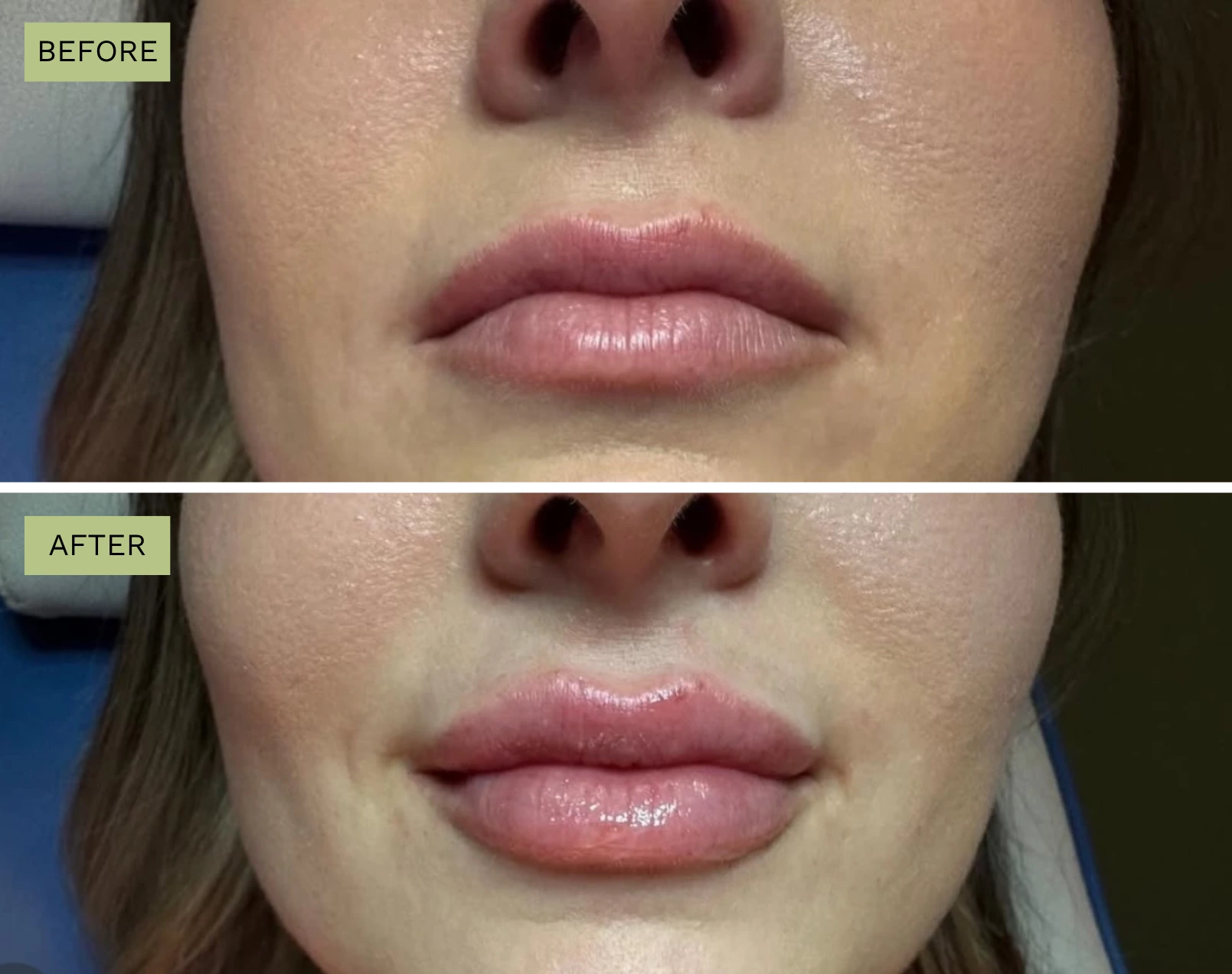 Elite Lips