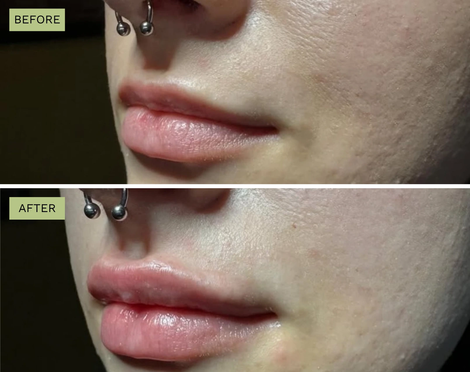 Elite Lips