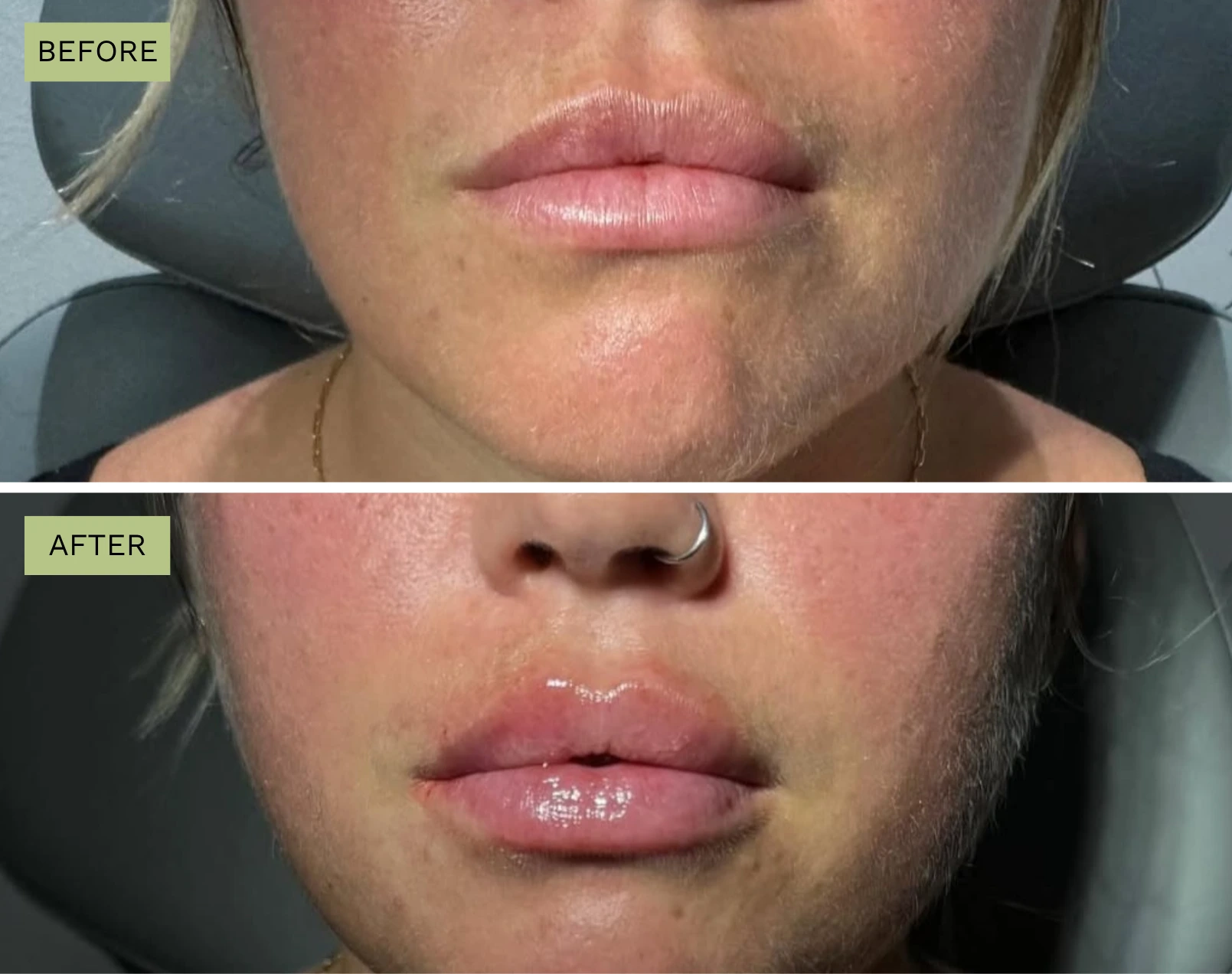 Elite Lips - Melanie Hartsell, APRN-C