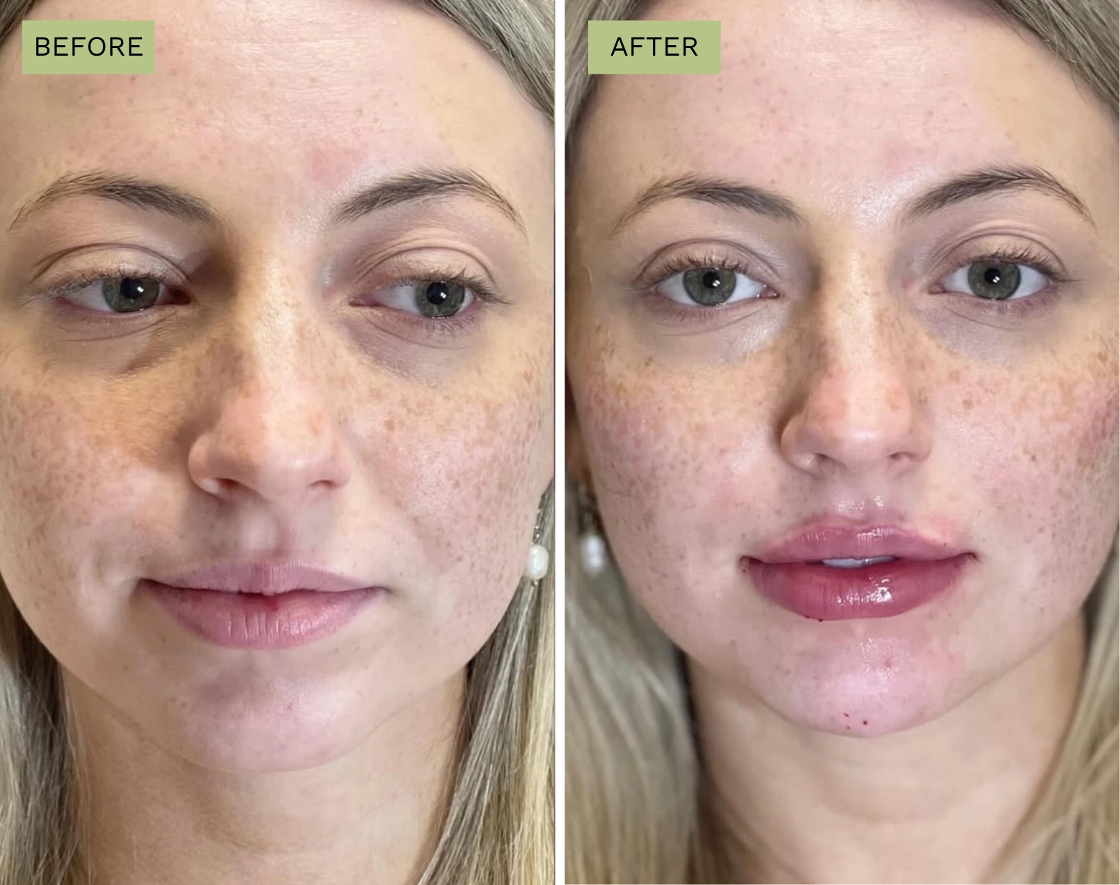 Elite Lips - Melanie Hartsell, APRN-C