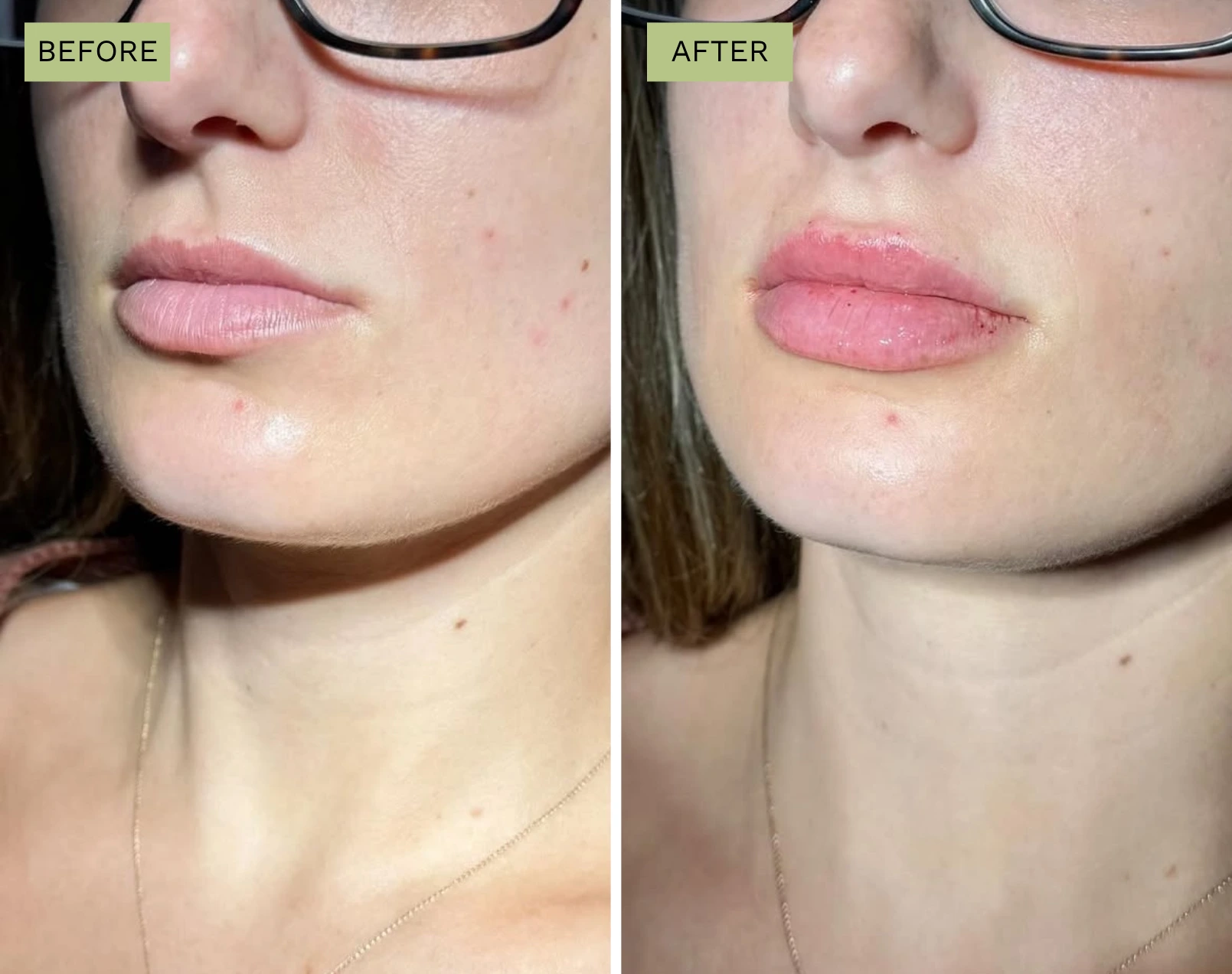 Elite Lips - Melanie Hartsell, APRN-C