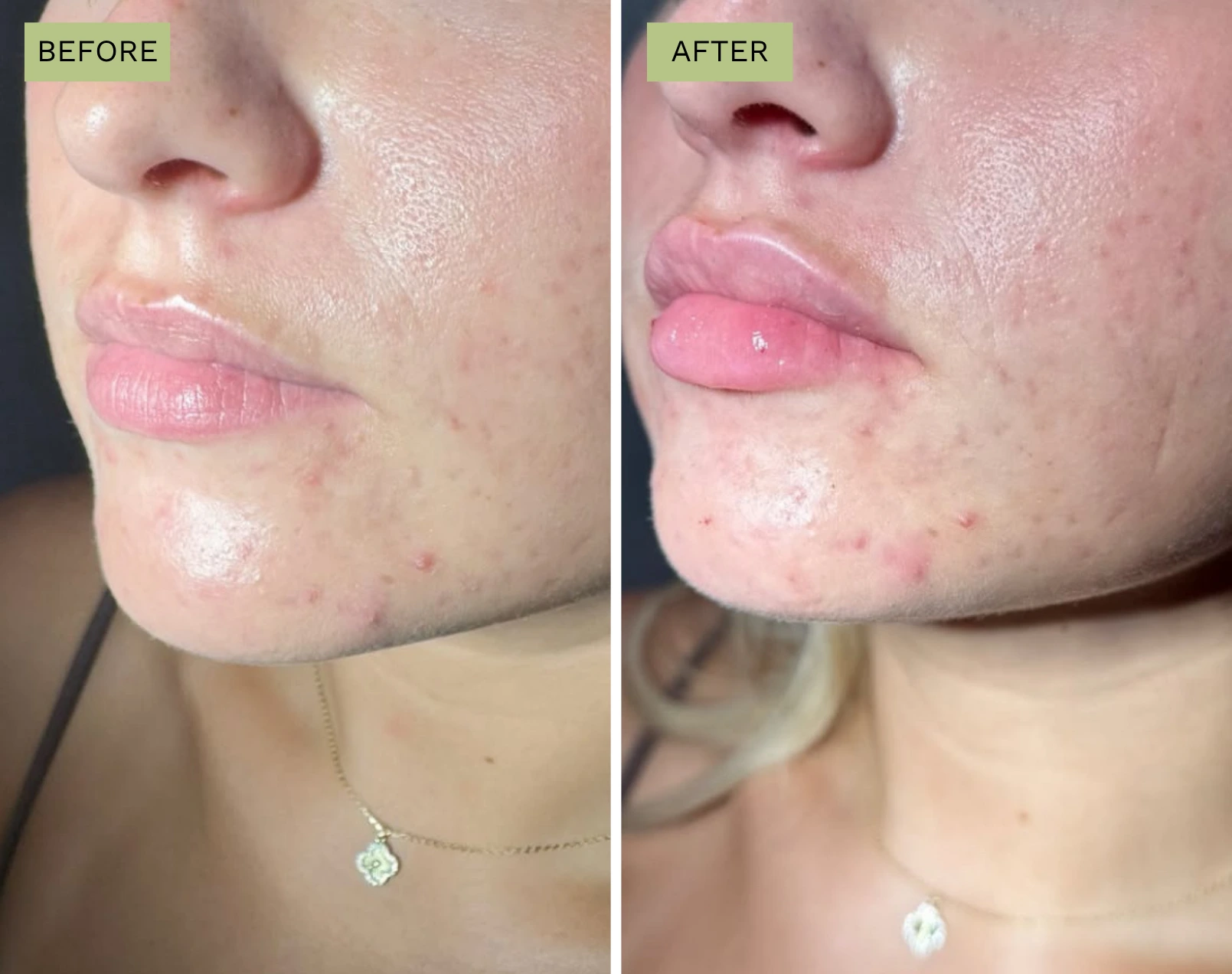 Elite Lips – Melanie Hartsell, APRN-C