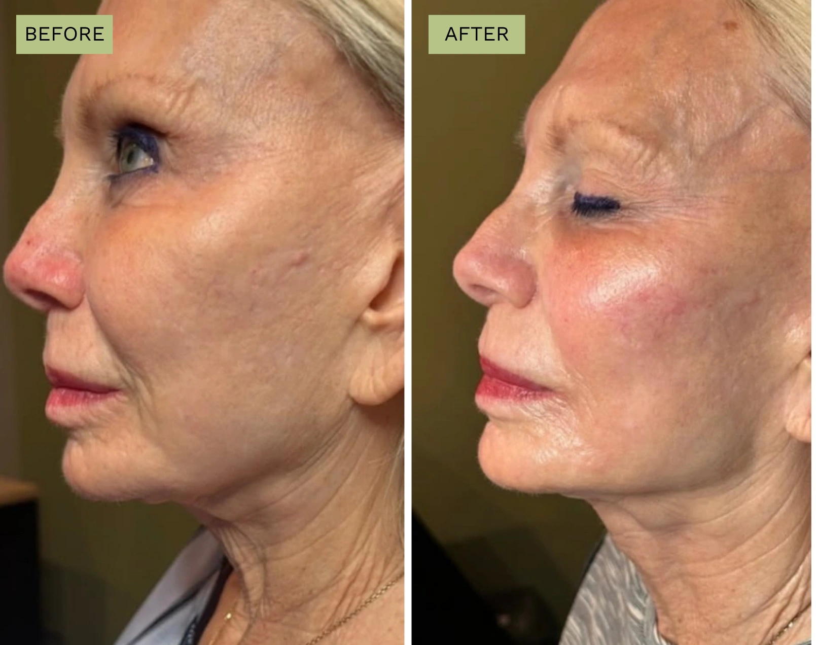 Elite Liquid Facelift  - Jeff Goldstein, PA-C