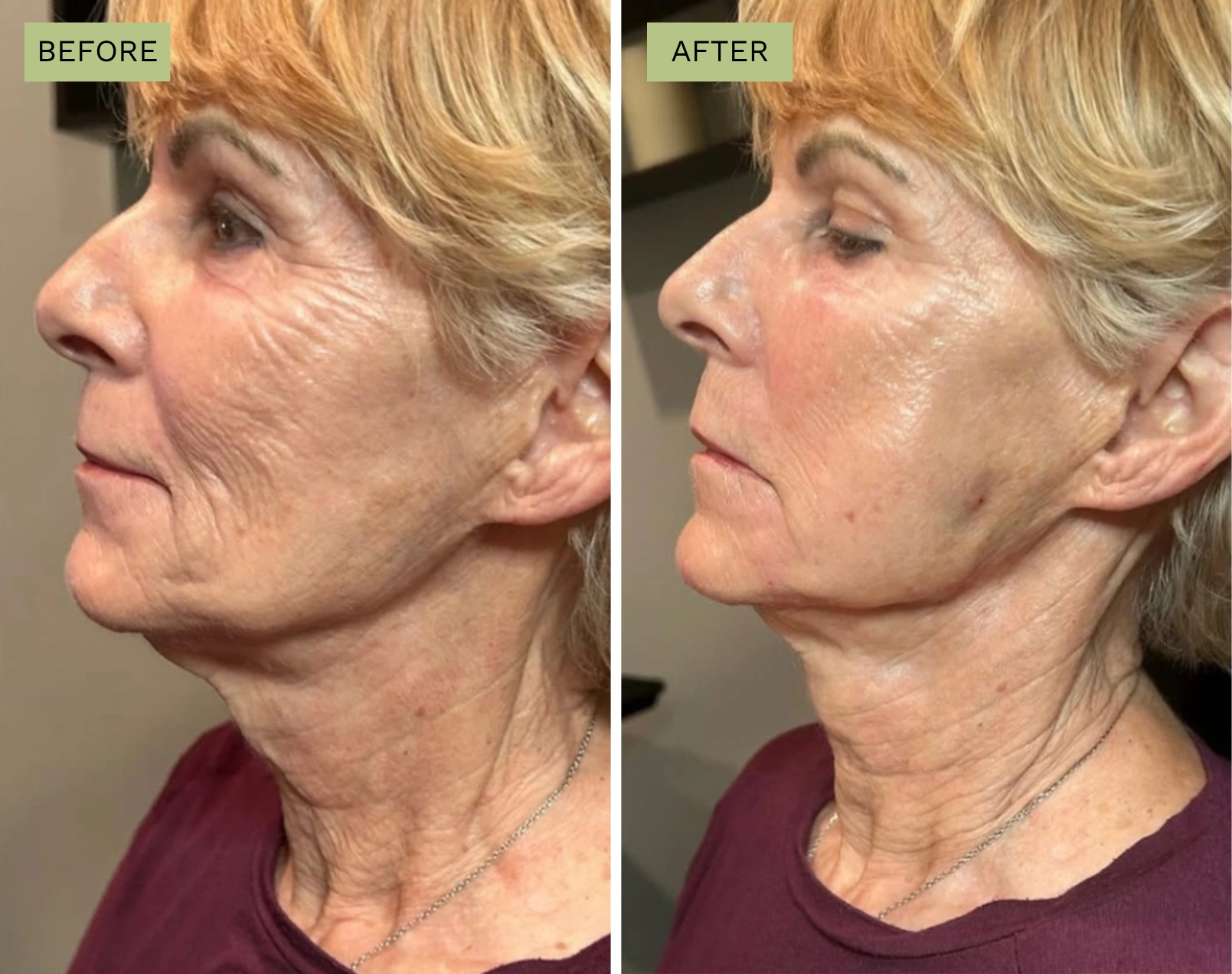 Elite Liquid Facelift  - Jeff Goldstein, PA-C