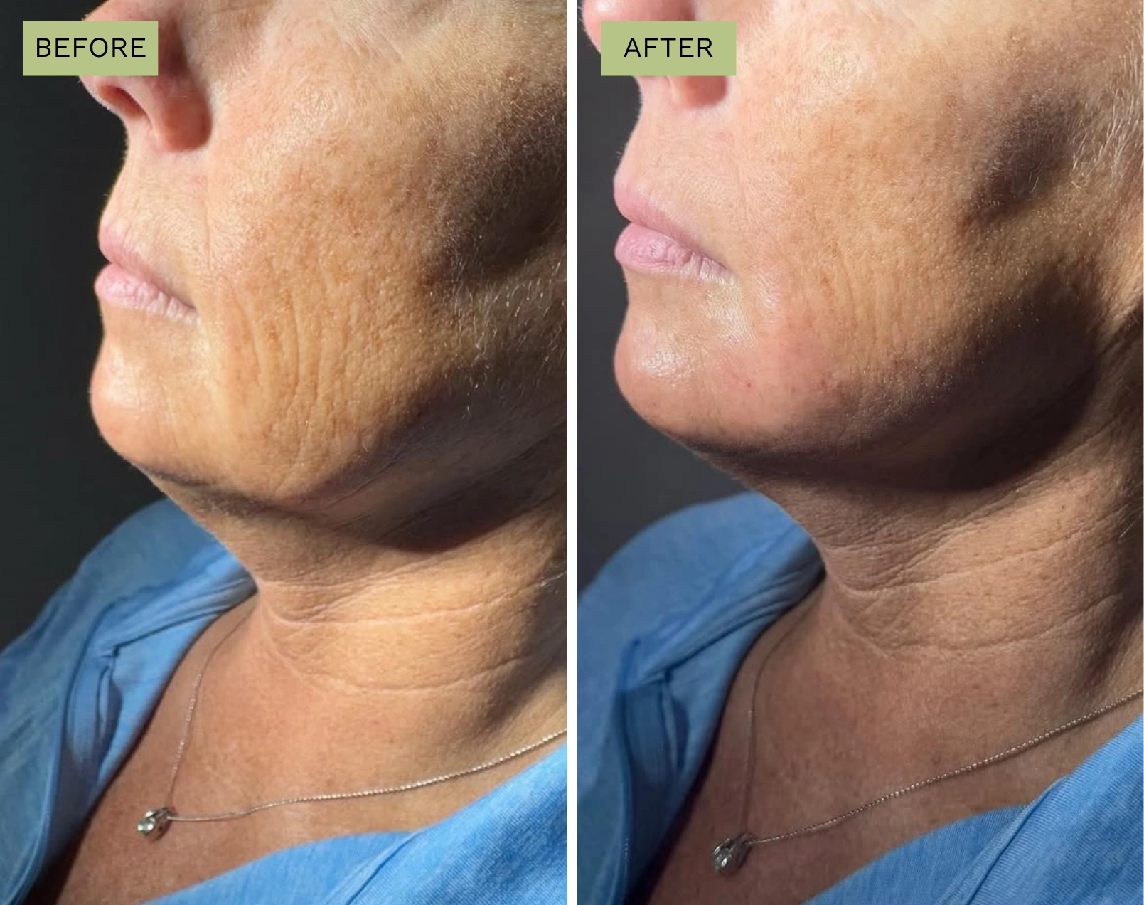 Elite Liquid Facelift  - Melanie Hartsell, APRN-C