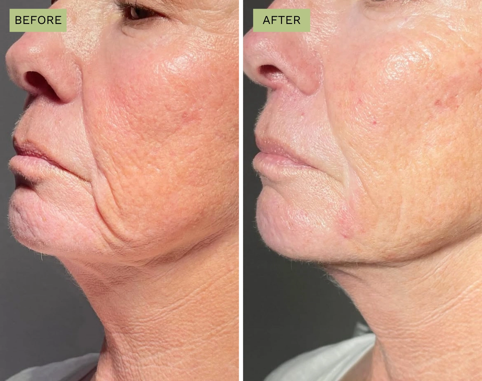 Elite Liquid Facelift - Melanie Hartsell, APRN-C