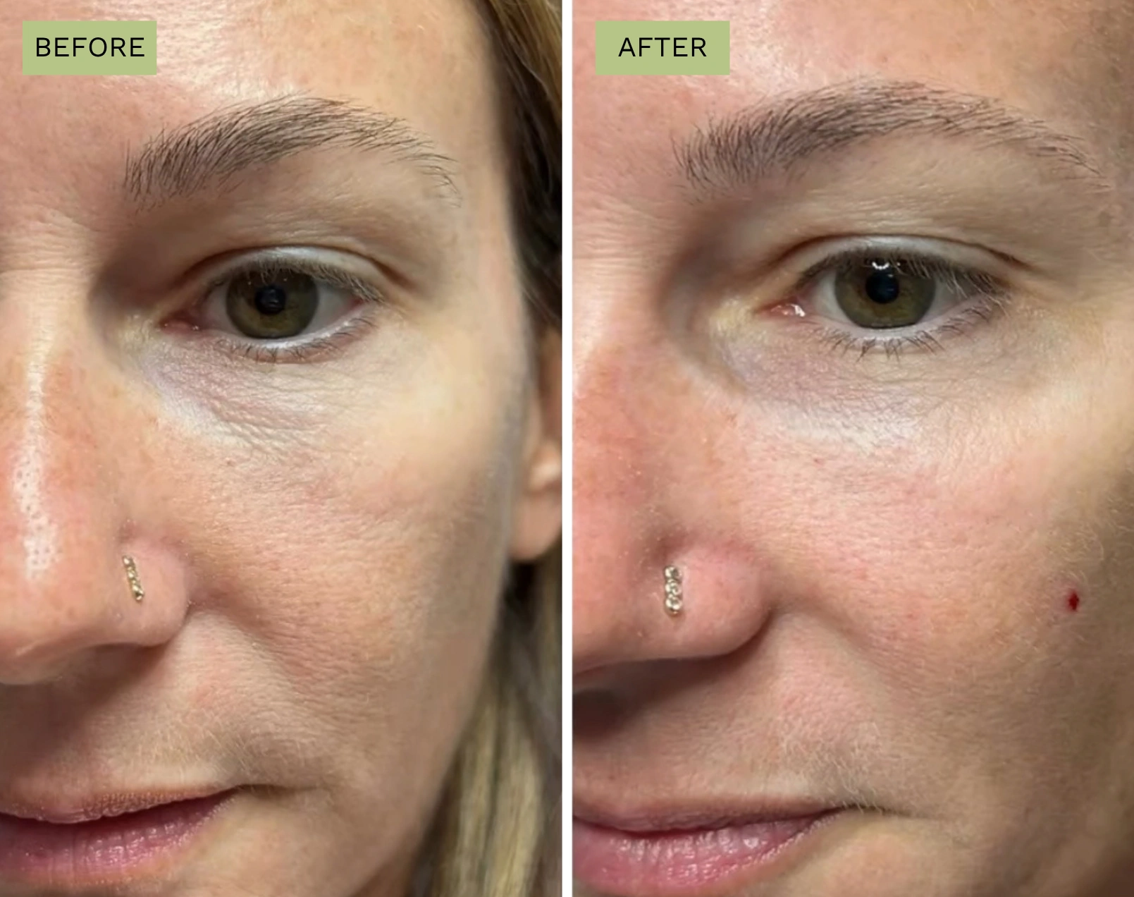 Elite Under Eyes – Jeff Goldstein, PA-C