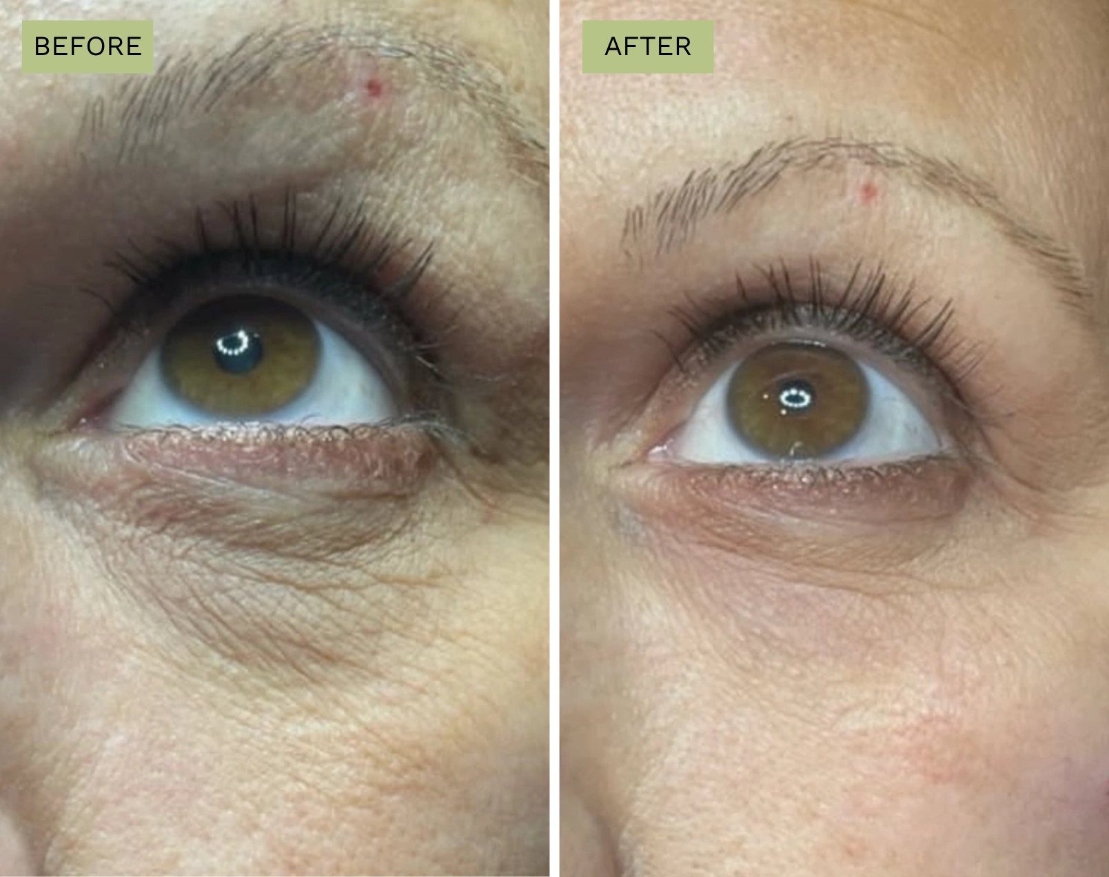 Elite Under Eyes - Jeff Goldstein, PA-C