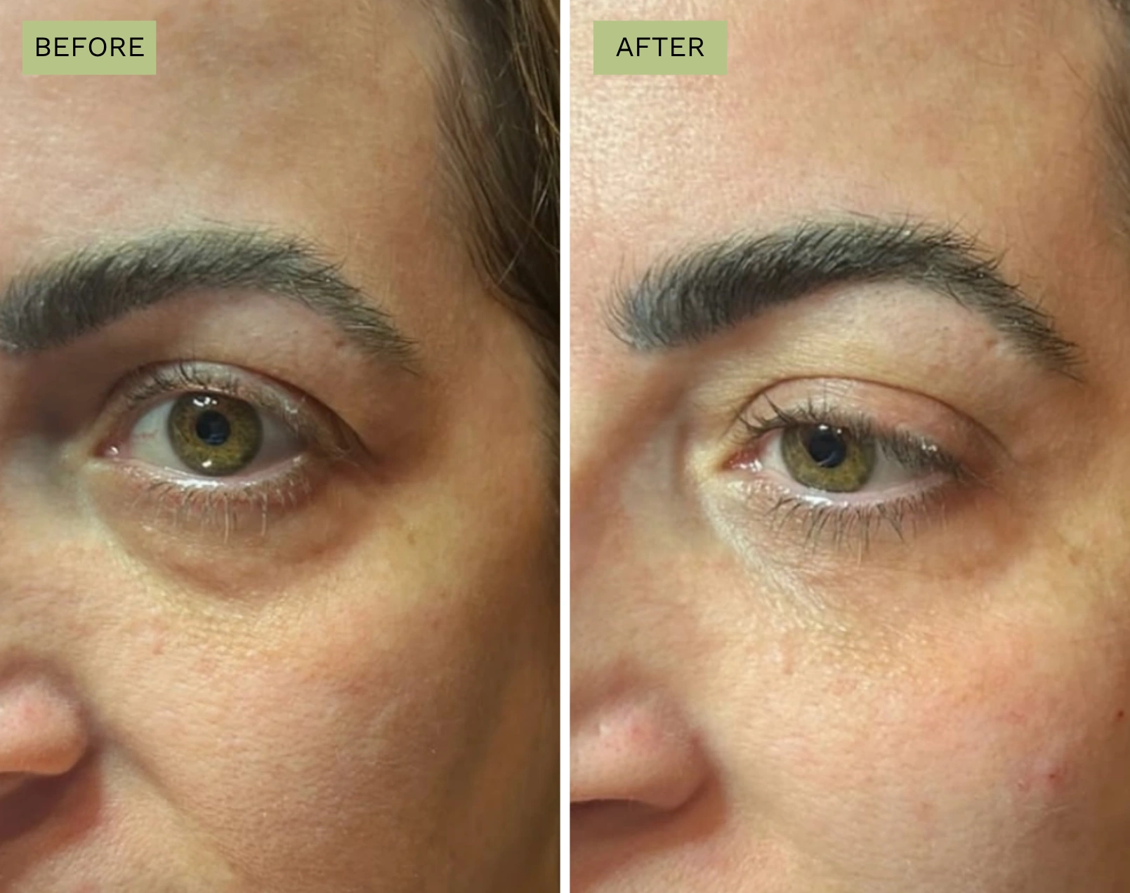 Elite Under Eyes - Jeff Goldstein, PA-C