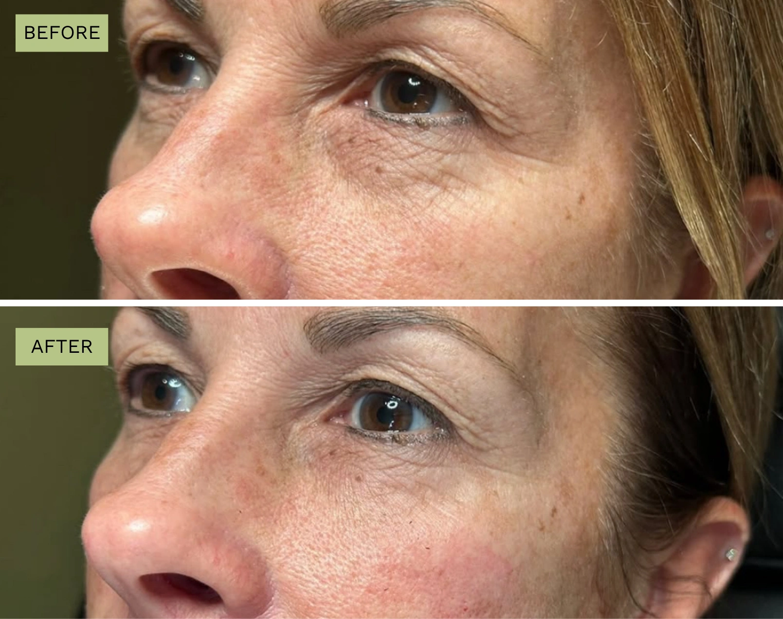 Elite Under Eyes – Jeff Goldstein, PA-C
