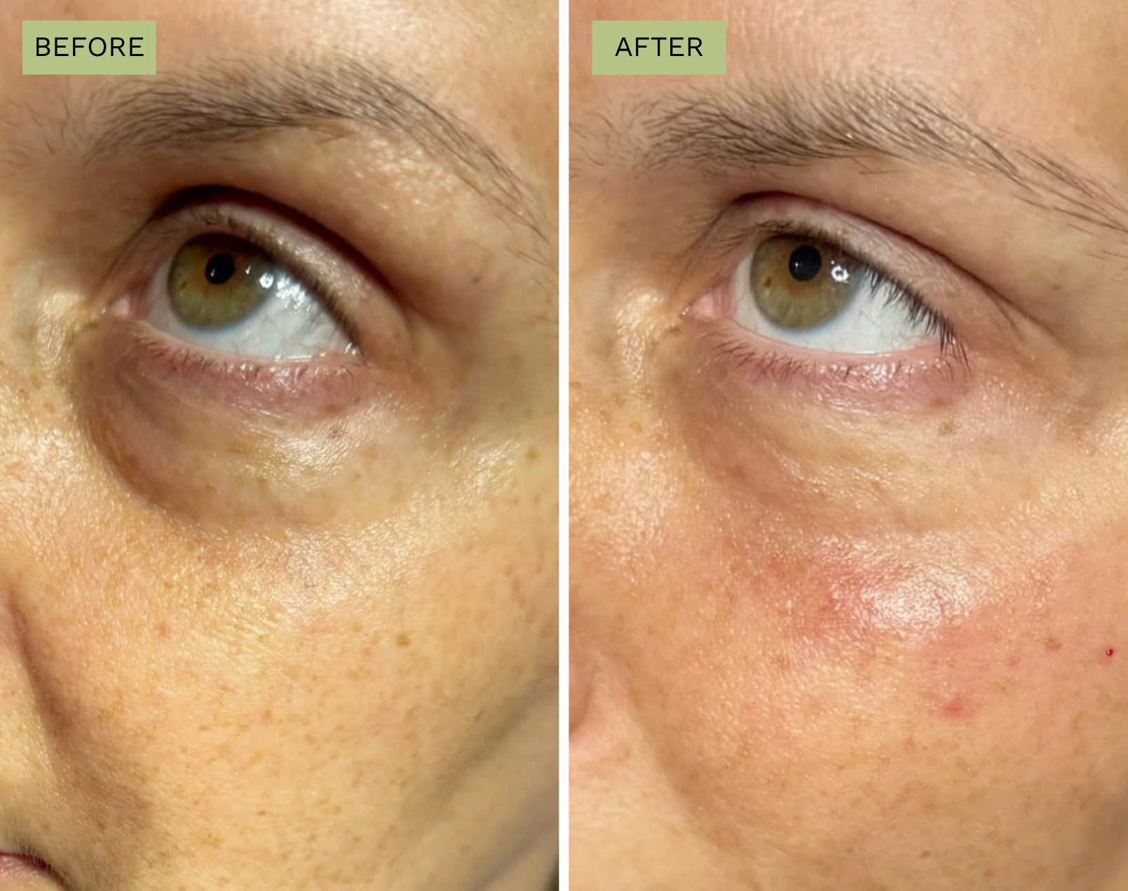 Elite Under Eyes – Melanie Hartsell, APRN-C