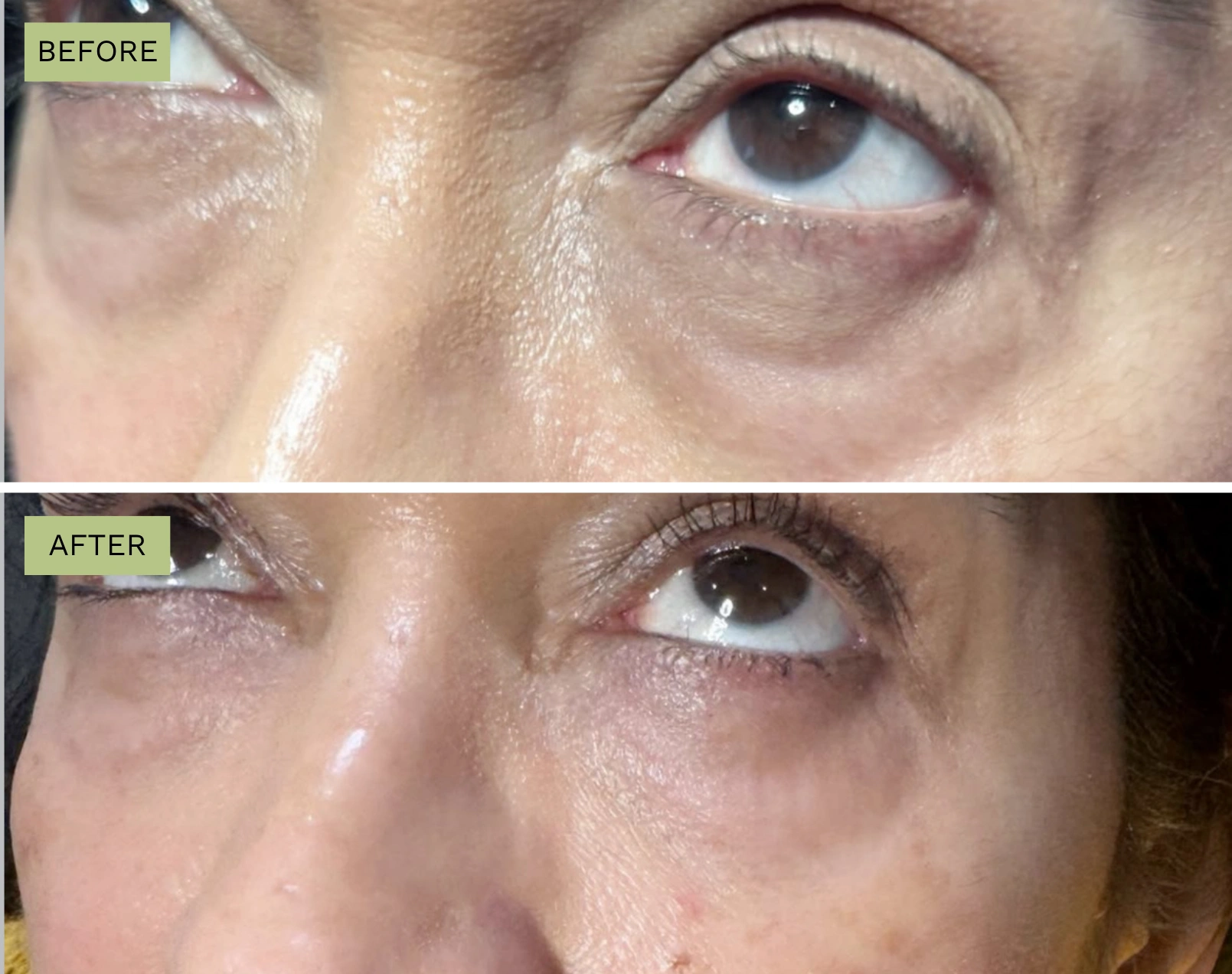 Elite Under Eyes – Melanie Hartsell, APRN-C