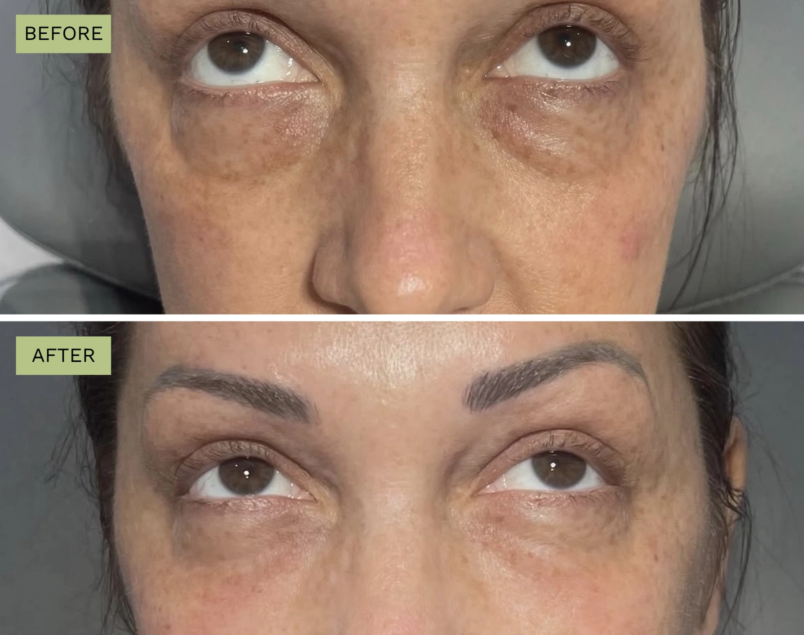 Elite Under Eyes – Melanie Hartsell, APRN-C