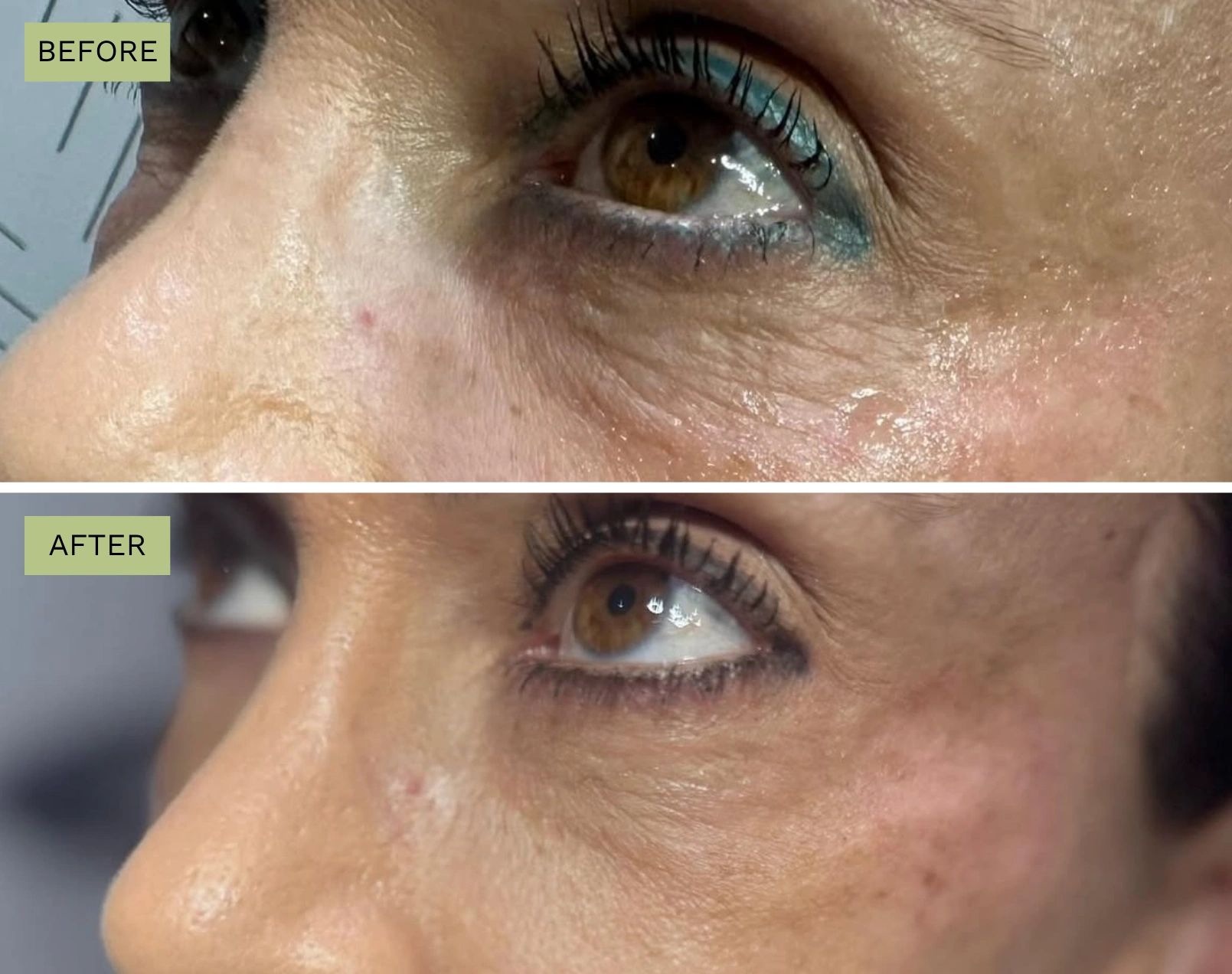 Elite Under Eyes - Melanie Hartsell, APRN-C