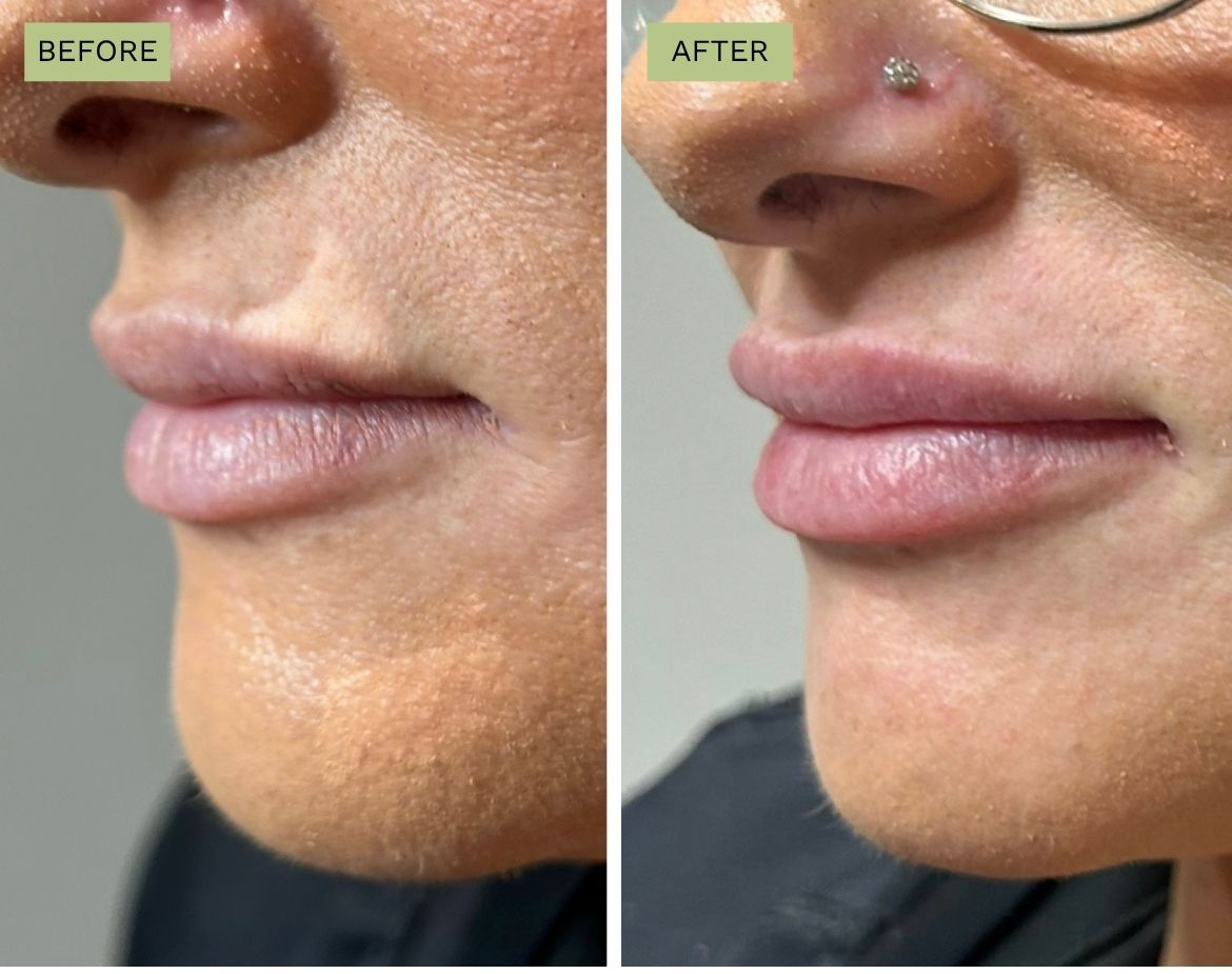 Elite Lips Filler with Juvéderm