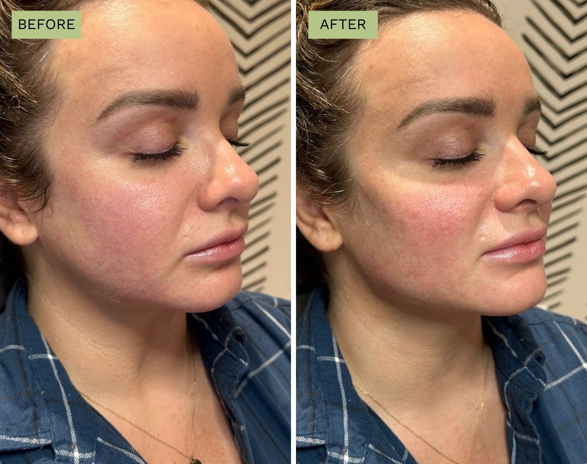 Elite Cheeks with Radiesse