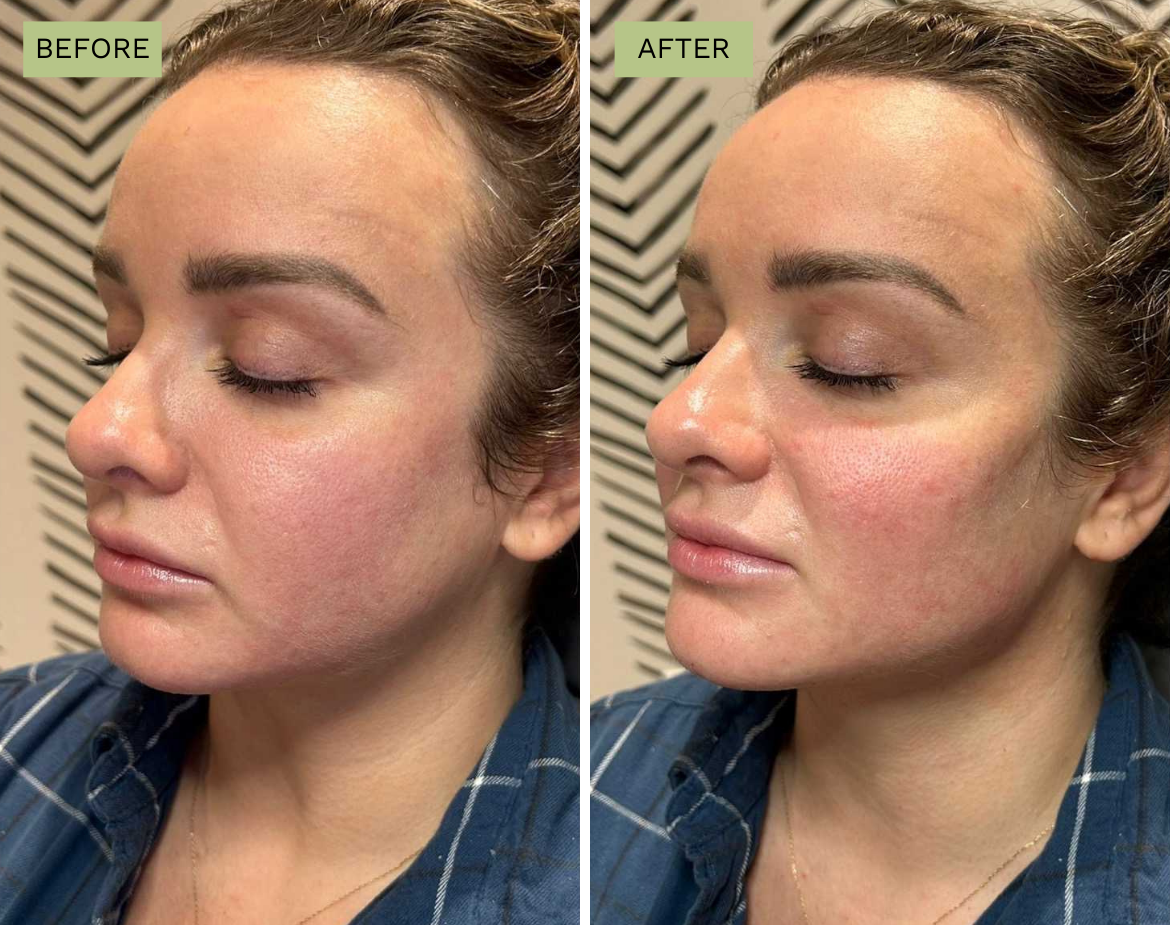 Elite Cheeks - Radiesse