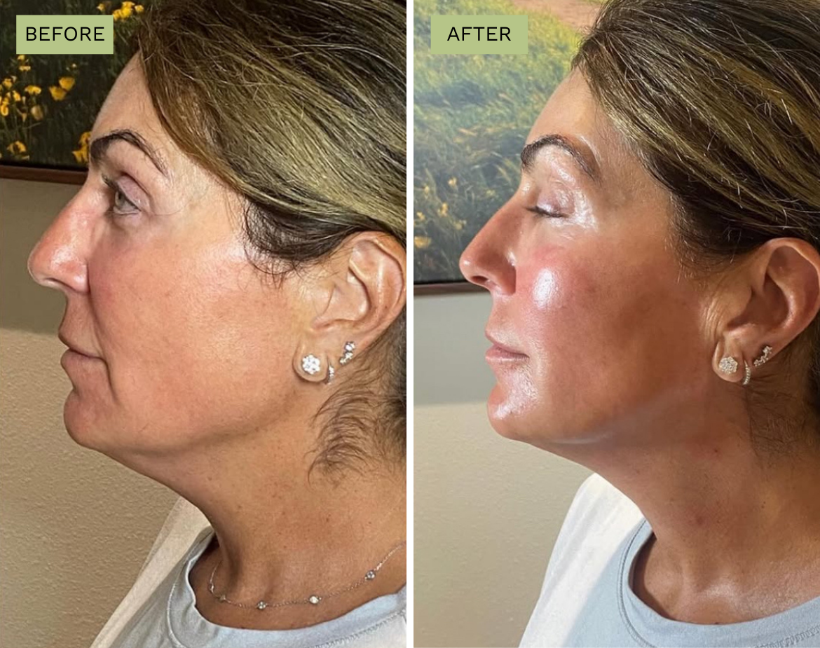 Elite Cheeks - Radiesse