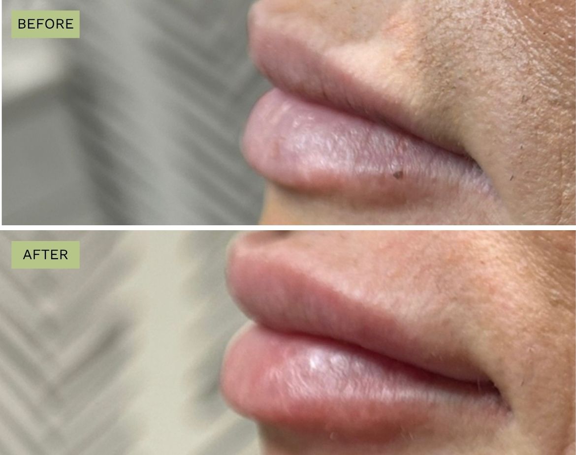 Elite Lips Filler with Juvéderm