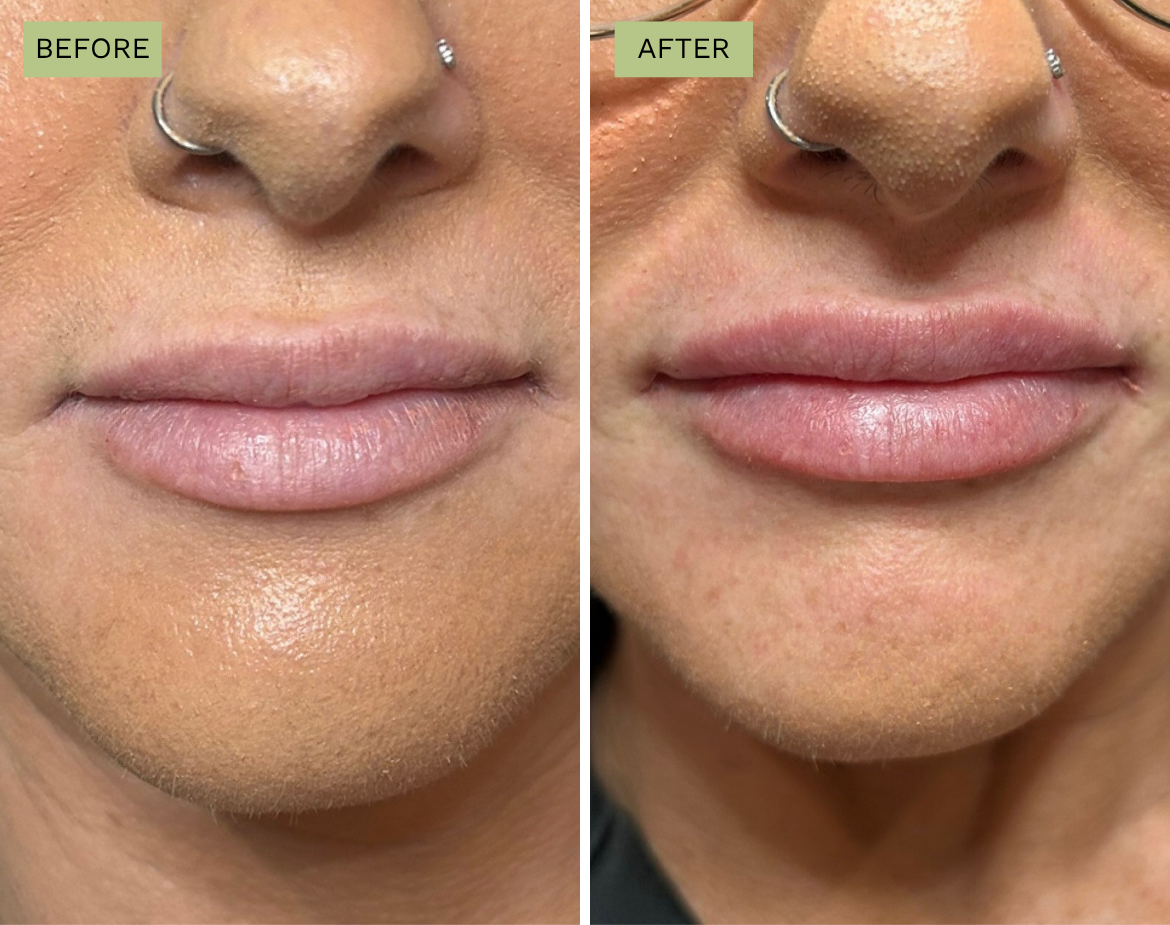 Elite Lips Filler with Juvéderm