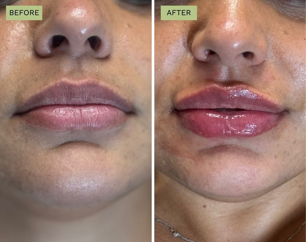 Elite Lips - Juvederm