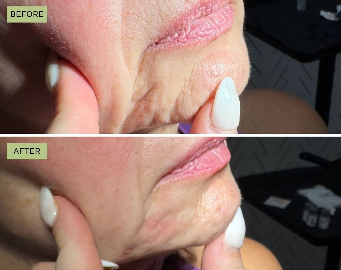 Elite Marrionettes with Juvederm Plus